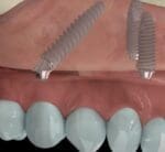 DM Plus Dental Implant by Bioner Spain