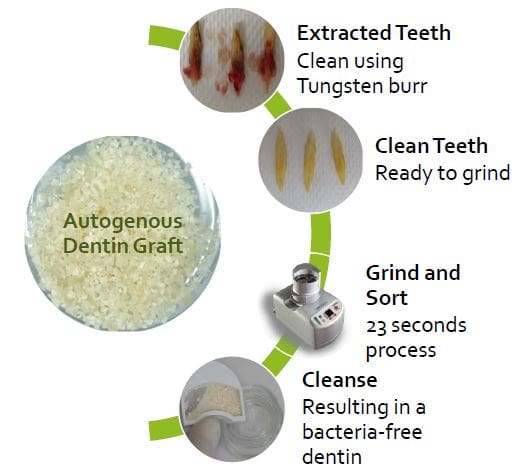 Tooth Grinder; Dentin Grinder