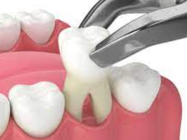 Tooth Grinder; Dentin Grinder