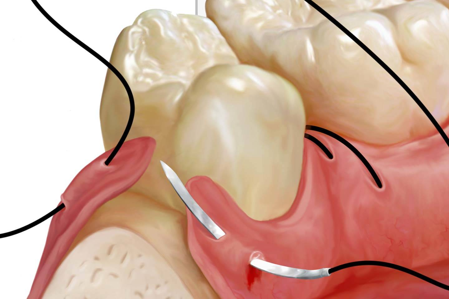 dental sutures at restore surgical